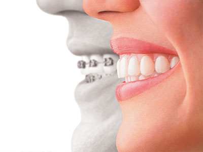 The image is a composite of two photos, one showing a smiling person and the other displaying a dental implant or bridge.