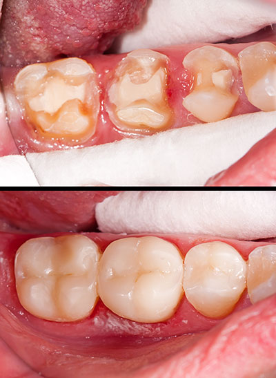 The image shows a close-up of an open mouth with damaged teeth, likely from decay or gum disease, and the surrounding tissue appears inflamed.