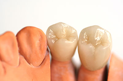 The image shows a set of three artificial teeth with different textures and colors, displayed against a white background.