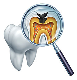 An illustration of a magnified tooth with an open pulp cavity, showing the interior structure and nerve endings, viewed through a magnifying glass.