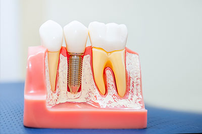 The image shows a close-up of three teeth with visible fillings, placed on a red dental mold or model, with a small metal screw or pin inserted into the middle tooth.