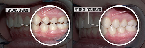 The image shows a side-by-side comparison of a normal oral cavity with teeth and gums, on the left, and an abnormal one with signs of occlusion or malocclusion, on the right.