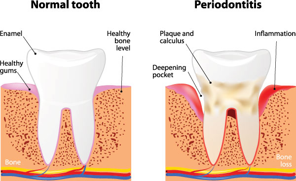 The image displays a medical illustration of the stages of tooth decay progressing from normal to severe, with labels indicating  normal,   periodontitis,  and  healthy bone.  It shows a healthy tooth on the left, an inflamed gum line in the center labeled  periodontitis,  and a severely decayed tooth on the right with a cavity. The illustration is educational, aiming to explain dental health issues.