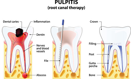 The image displays a diagrammatic representation of the human teeth and gums, with labels indicating the various parts such as  root canal therapy,   dental caries,   inflammation,  and  crown.  It also shows a toothbrush in contact with the teeth.