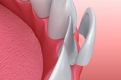 The image shows a close-up of a dental implant fixture with a pink gum background and a metallic screw visible.