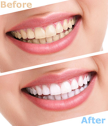 The image shows a before-and-after comparison of a person s teeth, with the left side showing yellowed teeth and the right side displaying bright white teeth after dental treatment.