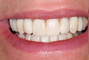 The image shows a close-up of a person s smiling mouth, displaying white teeth and gums.